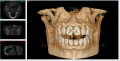Cone Beam: la nuova TC dentale in 3D